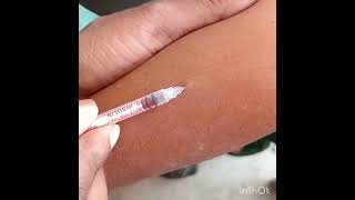 Mantoux test [upl. by Assirod]