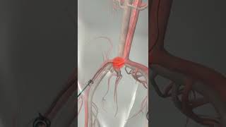 Learn How Cardiac Catheterization Works [upl. by Leidag]