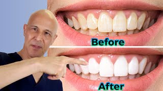 Whiten Your Teeth at Home the DIY Way  Dr Mandell [upl. by Kinsley]