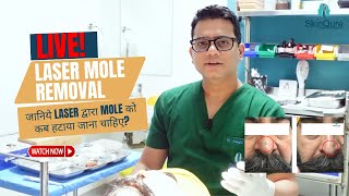 Live Mole Removal by Laser  Best Mole removal in Delhi  SkinQure  Dr Jangid [upl. by Ecirtnas]