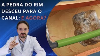 PEDRA NO RIM DE 5 MM É GRANDE  QUAL O TRATAMENTO PARA CÁLCULO RENAL PEQUENO [upl. by Nylidnarb]