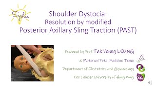 Shoulder Dystocia  Resolution by modified Posterior Axillary Sling Traction PAST  OBG CUHK [upl. by Suhail]