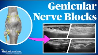 Ultrasound Guided Genicular Blocks 2024 update [upl. by Cohl]