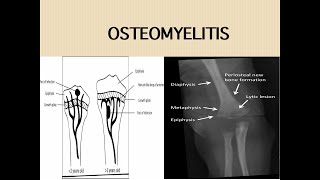 Acute Osteomyelitis [upl. by Aniretak]