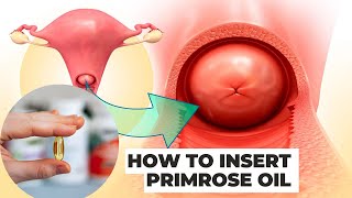 How to Insert Primrose Oil into the Cervix  Prepare for Labor Naturally [upl. by Nalor]