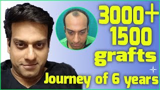 Hair Transplantation Result in 6 Years 4500 DHTFUE grafts NW 34 at 6 years Drs SethiBansal [upl. by Gnah]