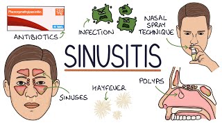 Understanding Sinusitis [upl. by Hillier988]