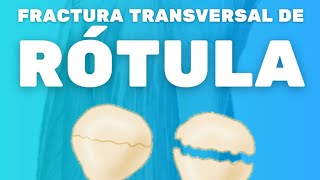 FRACTURA TRANSVERSAL DE RÓTULA [upl. by Efal]