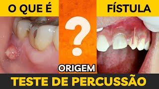 Teste de percussão e o rastreamento das fístula intraoral  Aula 5 [upl. by Ennovyahs]