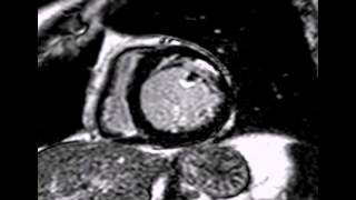 Cardiac MRI  LCx territory subendocardial infarction [upl. by Leith]