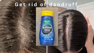 HOW TO GET RID OF DANDRUFF  Selsun Blue Anti Dandruff Shampoo  Honest Review [upl. by Erialcyram]