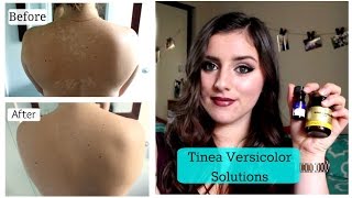 Tinea Versicolor SOLUTIONS TNBeauty94 [upl. by Darcie208]