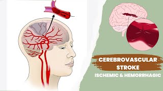 Cerebrovascular accident or stroke  Ischemic and hemorrhagic [upl. by Kannan303]