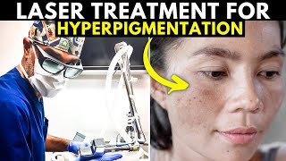 Do Lasers ACTUALLY WORK for Sun Spots Age Spots and Hyperpigmentation [upl. by Dranyer543]