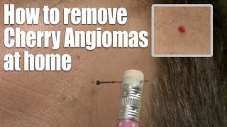 How to remove Red Skin Dots at home Quick amp Easy Cherry Angioma treatment [upl. by Durware]