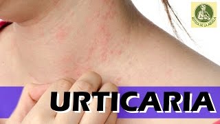 Urticaria – Remedios caseros para la urticaria  Urticaria en la piel [upl. by Bertila786]