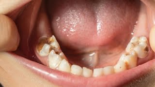 Dental Cavities Explained Causes Symptoms and Treatments You Need to Know [upl. by Nomaj393]