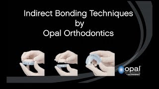 Indirect Bonding by Opal Orthodontics [upl. by Alves]