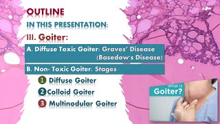 Goiter Graves disease multinodular goiter Thyroid lecture شرح محاضرة [upl. by Fonville307]