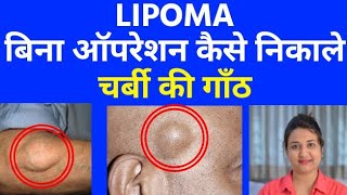 चर्बी की गाँठ  LIPOMA  को बिना ऑपरेशन कैसे निकाले । LIPOMA homeopathic treatment [upl. by Joelie368]