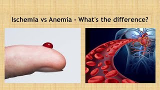 Ischemia vs Anaemia Simple way to learn [upl. by Nodlew260]