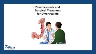 Diverticulosis and Surgical Treatment for Diverticulitis [upl. by Samtsirhc27]