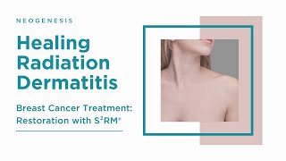 Radiation Dermatitis after Breast Cancer Treatment Restoration with S²RM® [upl. by Valtin]