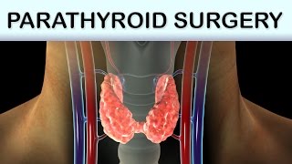 Parathyroid Surgery Medical Animation [upl. by Soluk]