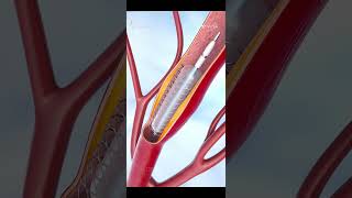 Coronary angioplasty and Stent insertion 3Dvideo animayion [upl. by Ylecic]