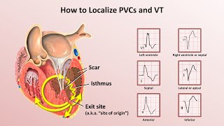 Advanced EKGs  Ventricular Tachycardia Classification amp Localization [upl. by Neelik51]