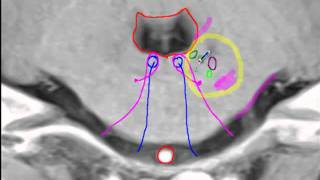 Anterior inferior cerebellar artery [upl. by Aneerhs]