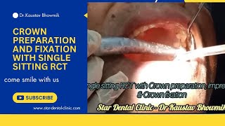 Crown preparation and fixation with single sitting RCT [upl. by Enyawal677]