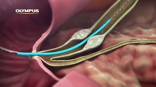 QuickPlaceV Biliary Stent [upl. by Susejedesoj]