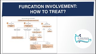 DECISION MAKING FURCATION INVOLVEMENT HOW TO TREAT DR ANKITA KOTECHA DENTAL STUDIES SIMPLIFIED [upl. by Annohsat]