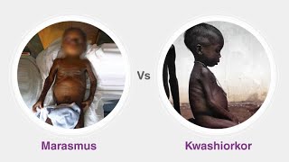 Malnutrition  Marasmus  Kawashiorkor  Protein energy malnutrition  Disease under 5 year Children [upl. by Wallford628]