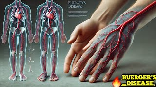 Buergers Disease Thromboangiitis Obliterans Easy Explanation [upl. by Lleuqar]