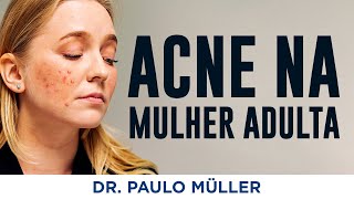 Acne na Mulher Adulta  Dr Paulo Müller Dermatologista [upl. by Lemkul]