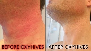 How To Get Rid Of Hives With The OxyHives Hives Treatment [upl. by Galang975]