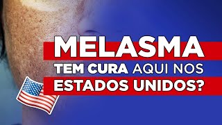 Melasma tem cura aqui nos Estados Unidos [upl. by Braasch534]