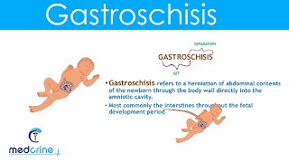 Gastroschisis Definition Causes and Diferences with Omphalocele [upl. by Assenyl]