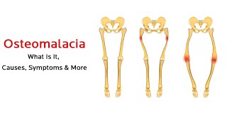 What is osteomalacia [upl. by Dione425]