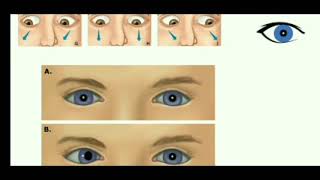 Broad H Test and its clinical Presentation ophthalmology optometry binocularvision [upl. by Rolf392]