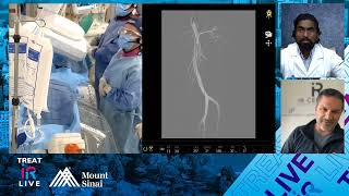 Transradial Genicular Artery Embolization GAE for Knee Osteoarthritis OA [upl. by Alleuol]