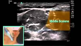 UltrasoundGuided Interscalene Brachial Plexus Nerve Block  SonoSitemp4 [upl. by Yevi]