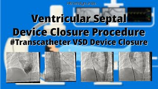 VSD VSD Device Closure Transcatheter VSD Device Closure [upl. by Edrei160]