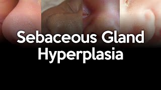 Sebaceous gland hyperplasia in the newborn [upl. by Alvy]