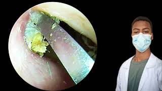 JawDropping Ear Wax Removal You Won’t Believe Your Eyesearearwax earwaxremovalearrelaxasmr [upl. by Ardeha]