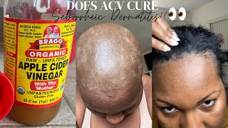 Treating My Seborrheic Dermatitis with ACV RINSE Remedy 🙆🏾😫👀😅 [upl. by Ainevul668]