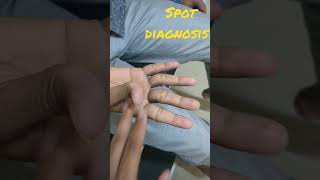 Spot diagnosis Handgrip myotonia in myotonic dystrophy DrKamaleshTNMediCalLectures [upl. by Alian]