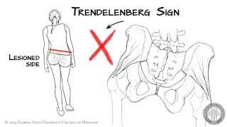 The Trendelenberg Sign HD [upl. by Ahseele502]